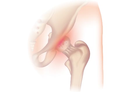 Osteoarthritis of the hip