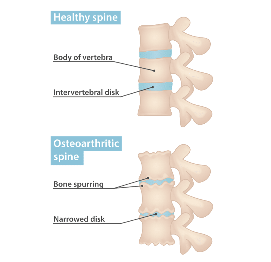 Osteoarthritis of the spine