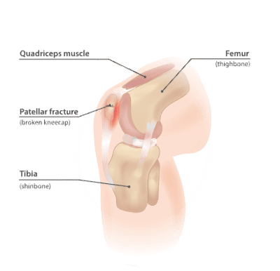 Patellar fracture