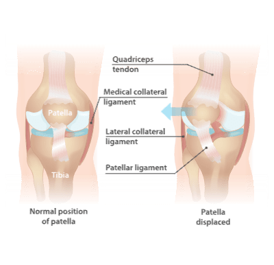 Patellar dislocation