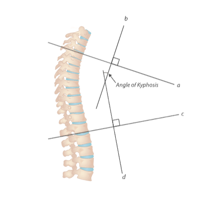 Measurement of kyphosis (Dowager's Hump)