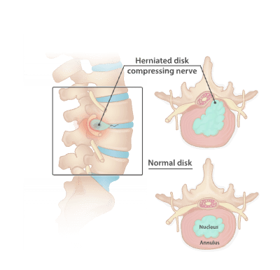 Herniated disk