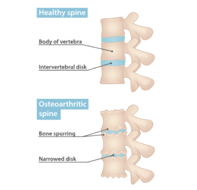 Osteoarthritic spine