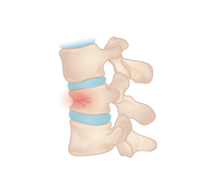 Spine Injury