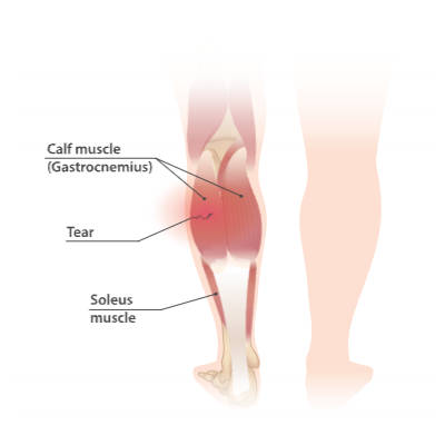 Calf muscle strain and tear