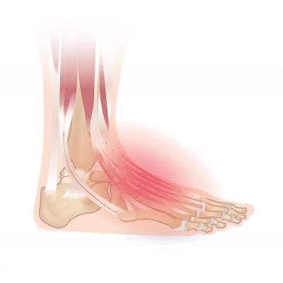 Extensor tendonitis