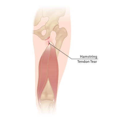 Hamstring tear