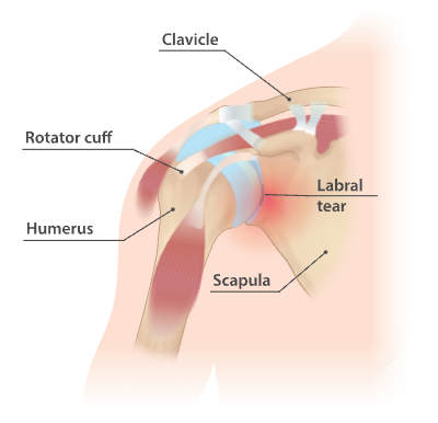 Labral tear