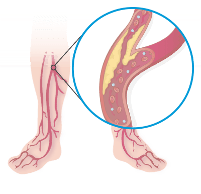 Peripheral artery disease