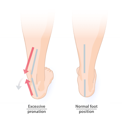 Pronation of the foot