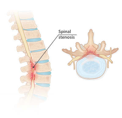 Spinal stenosis