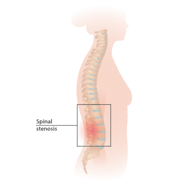 Spinal stenosis side