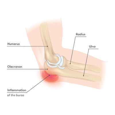 Elbow - Inflamation of the bursa