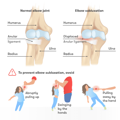 Elbow subluxation