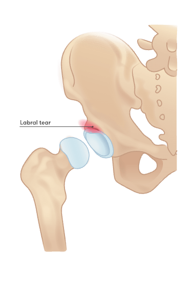 Labral tear