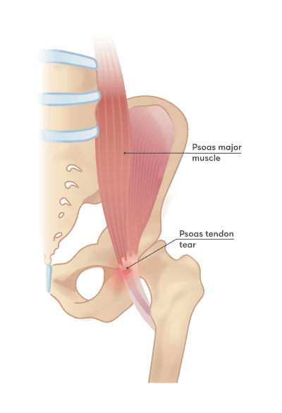 Psoas tendon tear