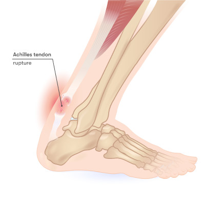 Achilles tendon rupture