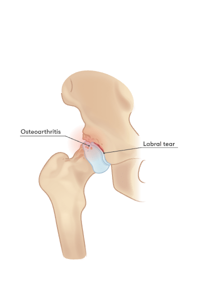 Hip Osteoarthritis