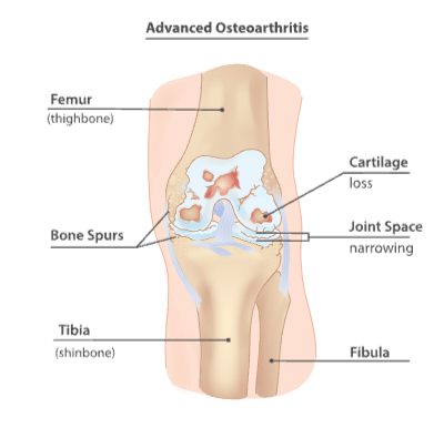 Knee Osteoarthritis