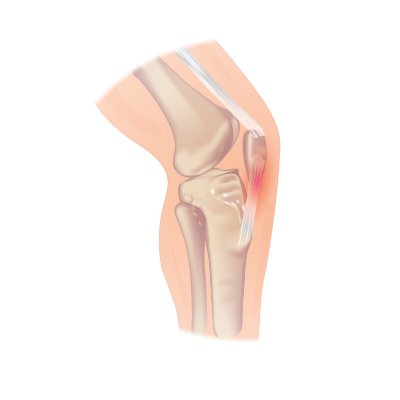 Pain in the soft tissue of your knee