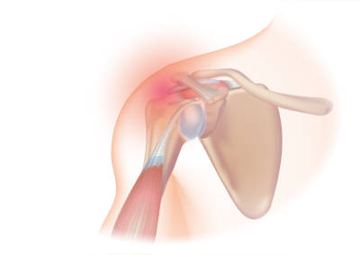 Shoulder pain