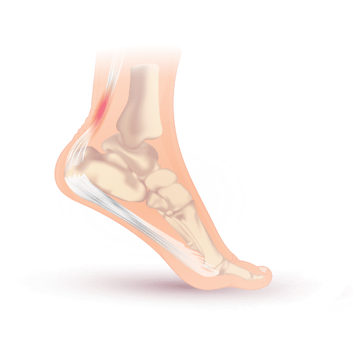 Inflammation of the Achilles tendon