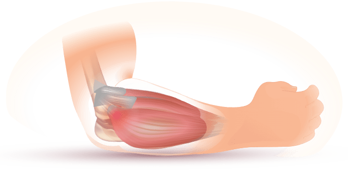 Tennis elbow (lateral epicondylitis)