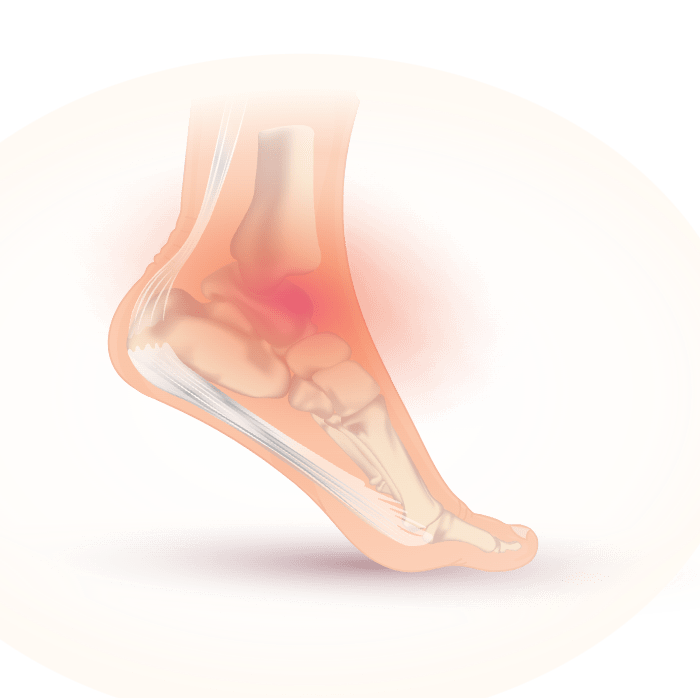 Know Your Injury: The Difference Between a Sprain, a Strain and a Tear