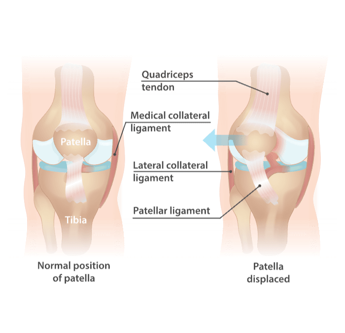 Why Does My Knee Hurt? 10 Common Sources of Knee Pain