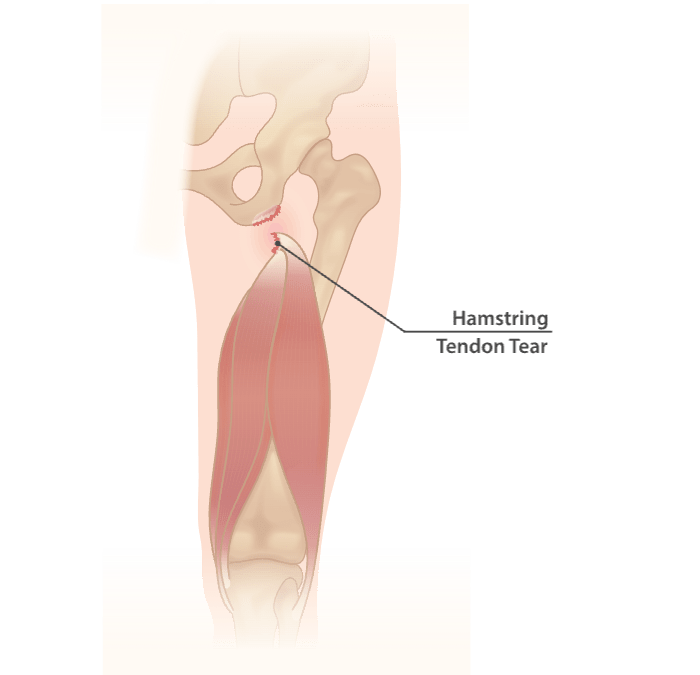 Hamstring tear