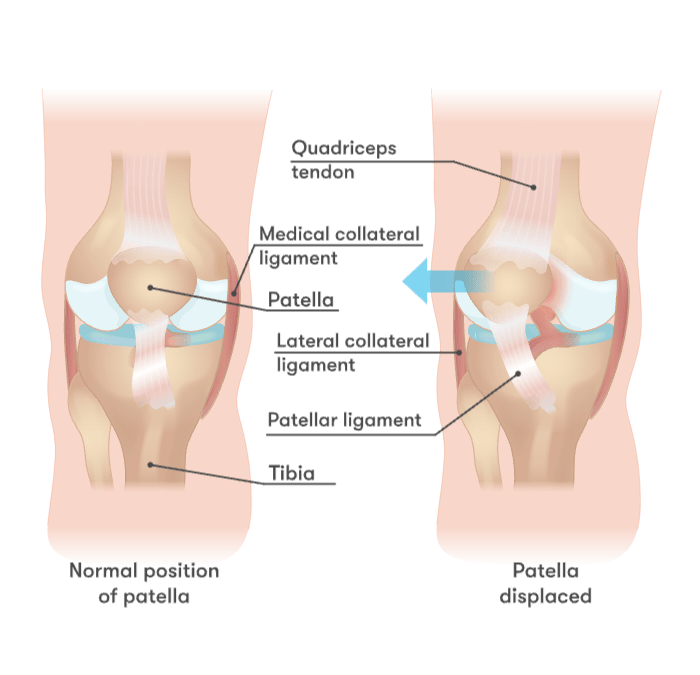 Dislocated kneecap / Patellar dislocation