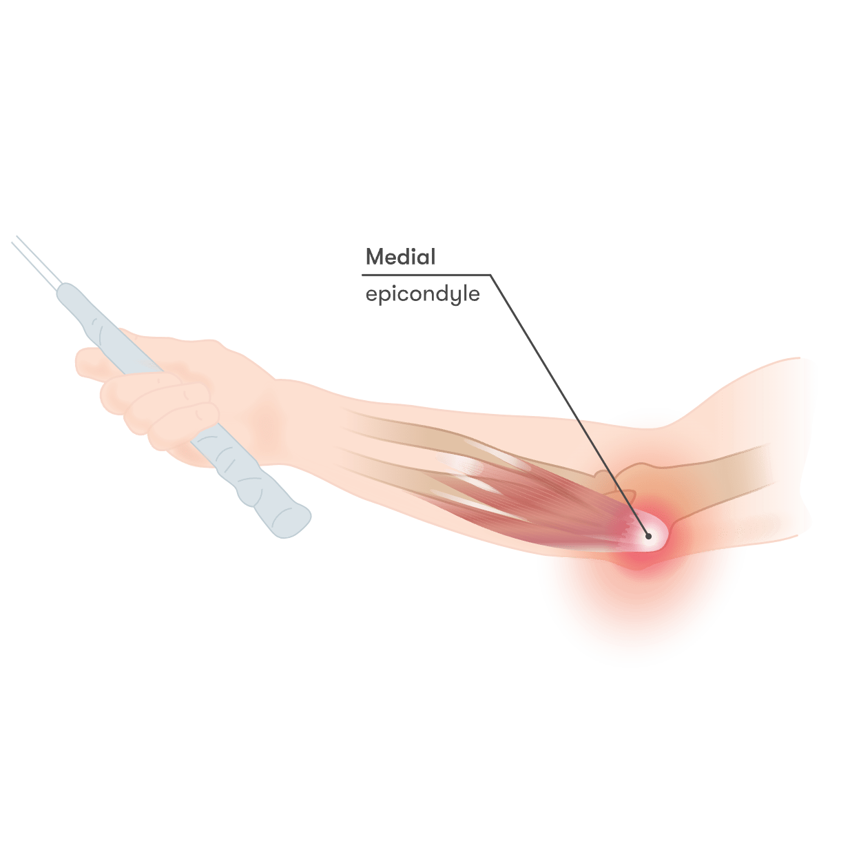 Golfer's elbow