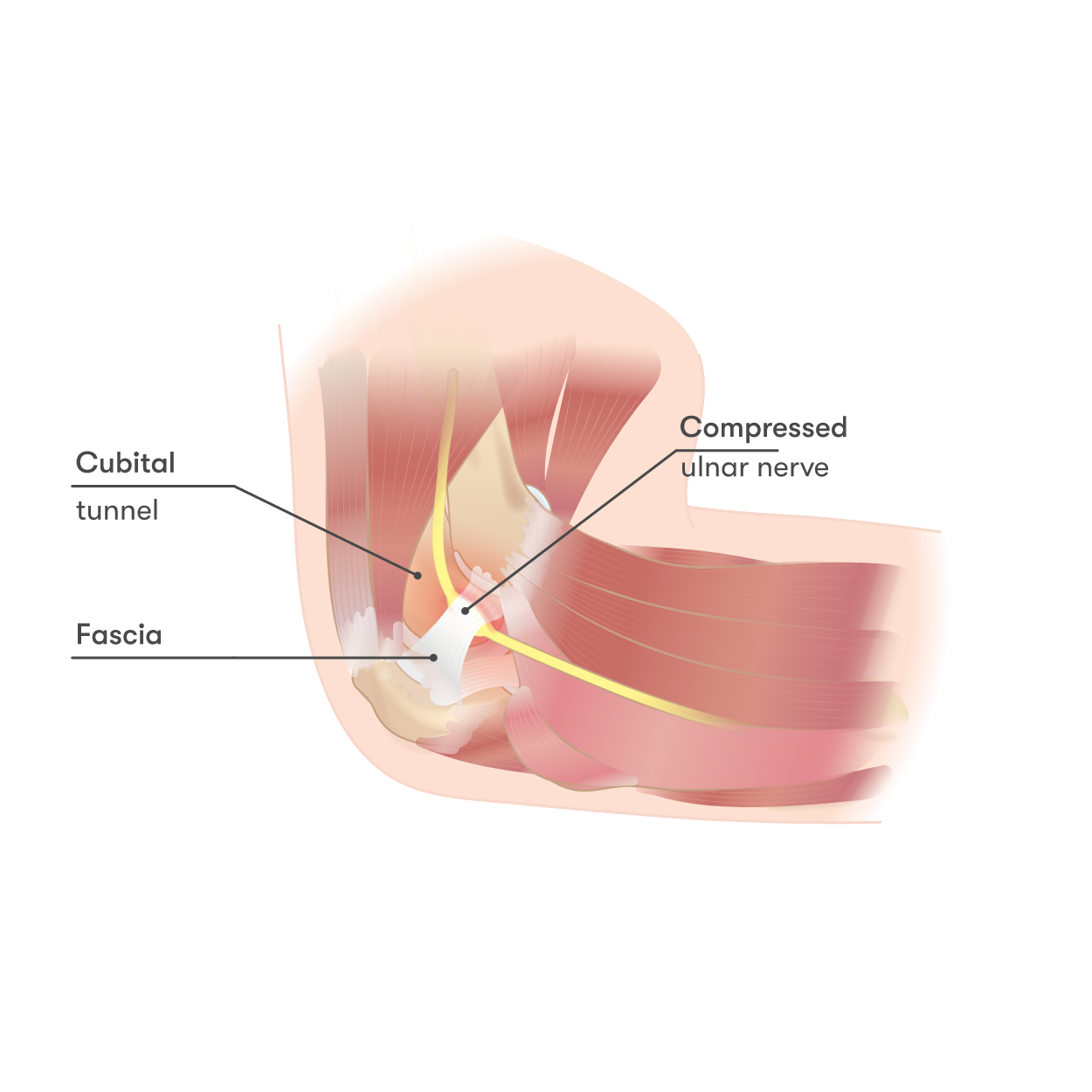 Compressed ulnar nerve