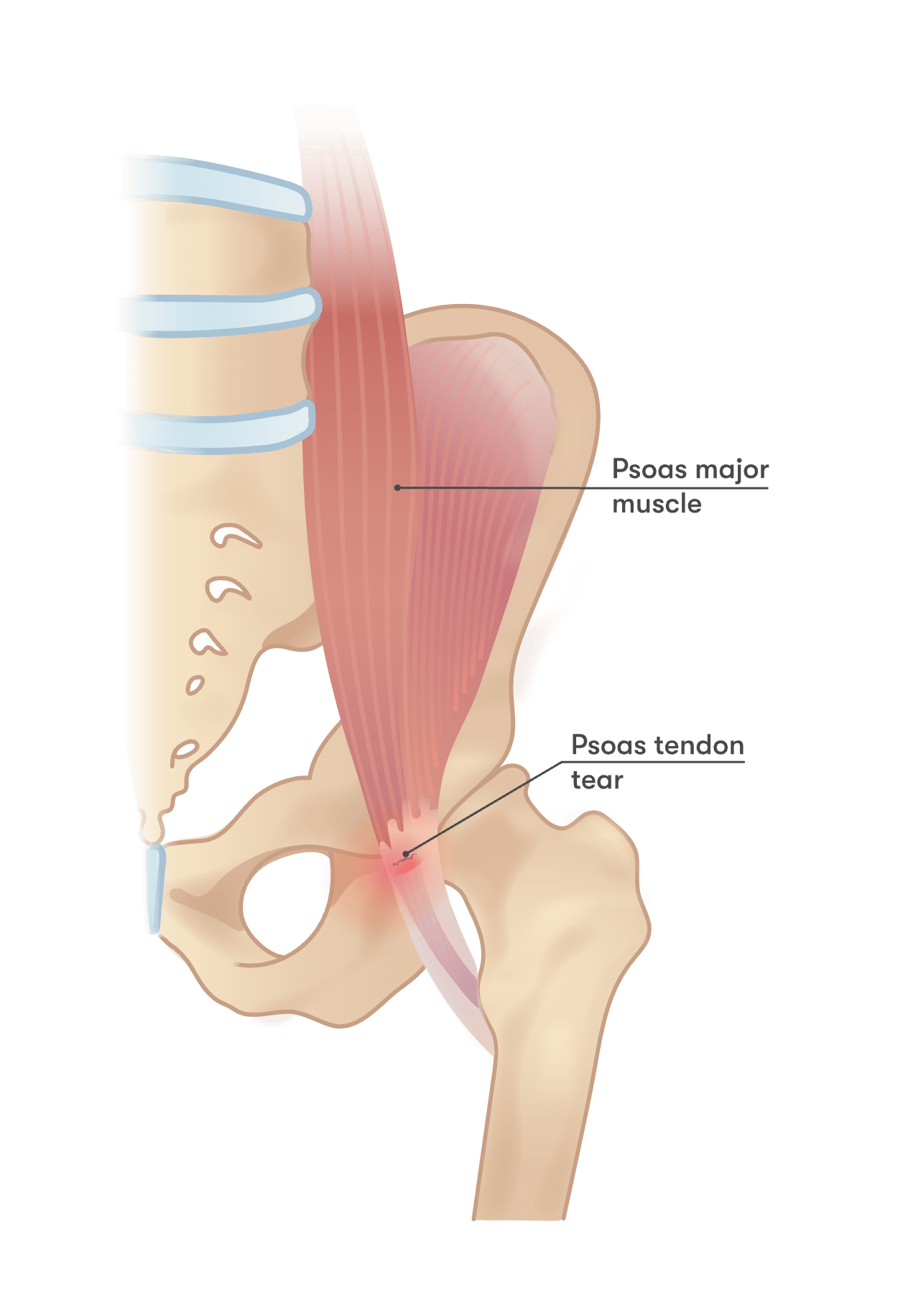 Iliopsoas tendinitist