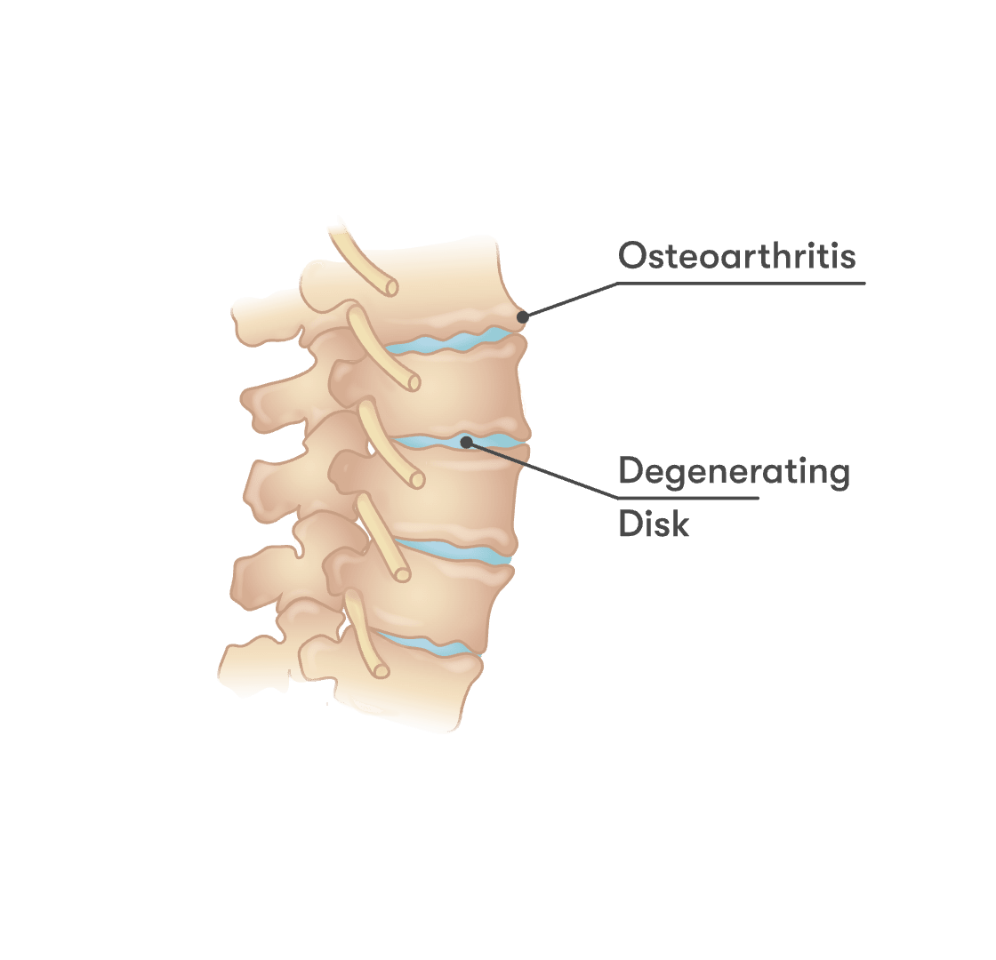 Spinal disk degeneration