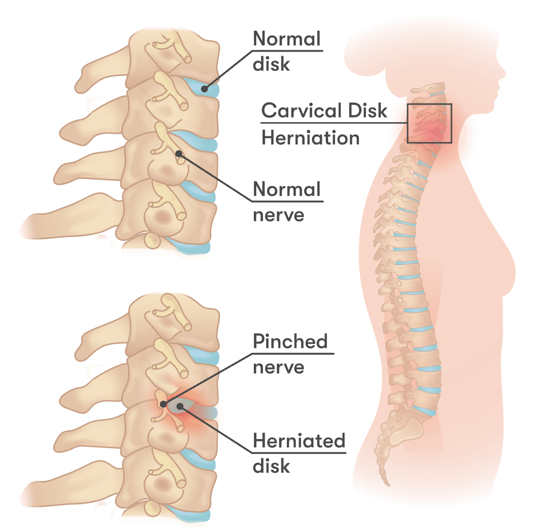 Pinched Nerve Treatment - Neck & Arm Pain Therapy