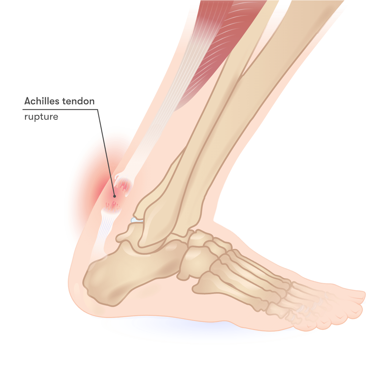 mild achilles tendonitis