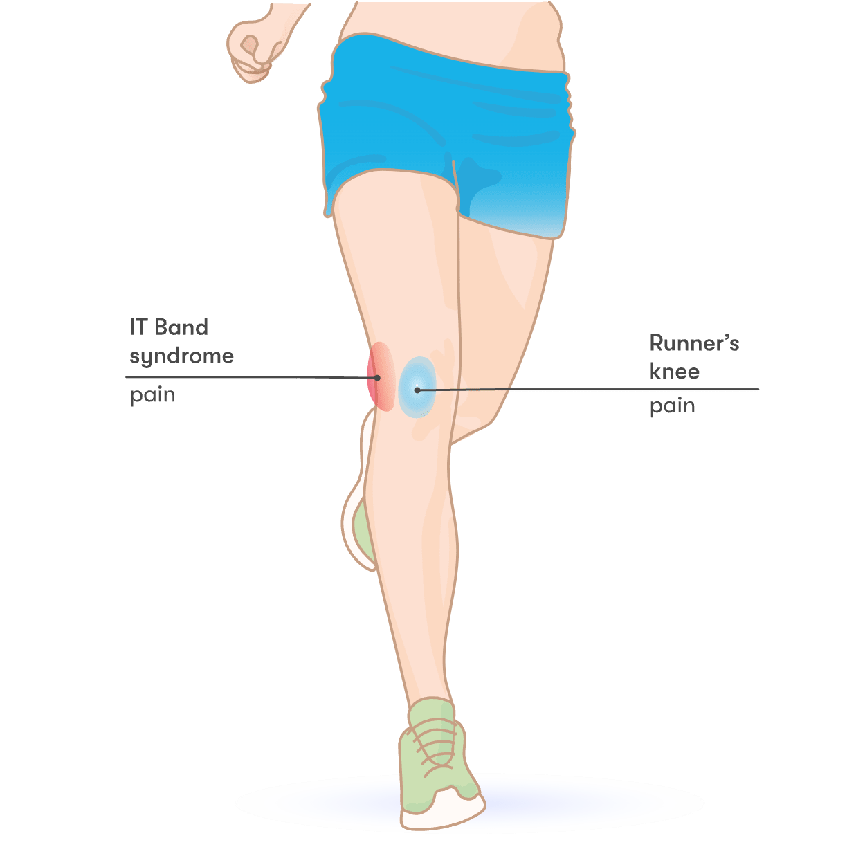 Runner's knee:causes, treatment