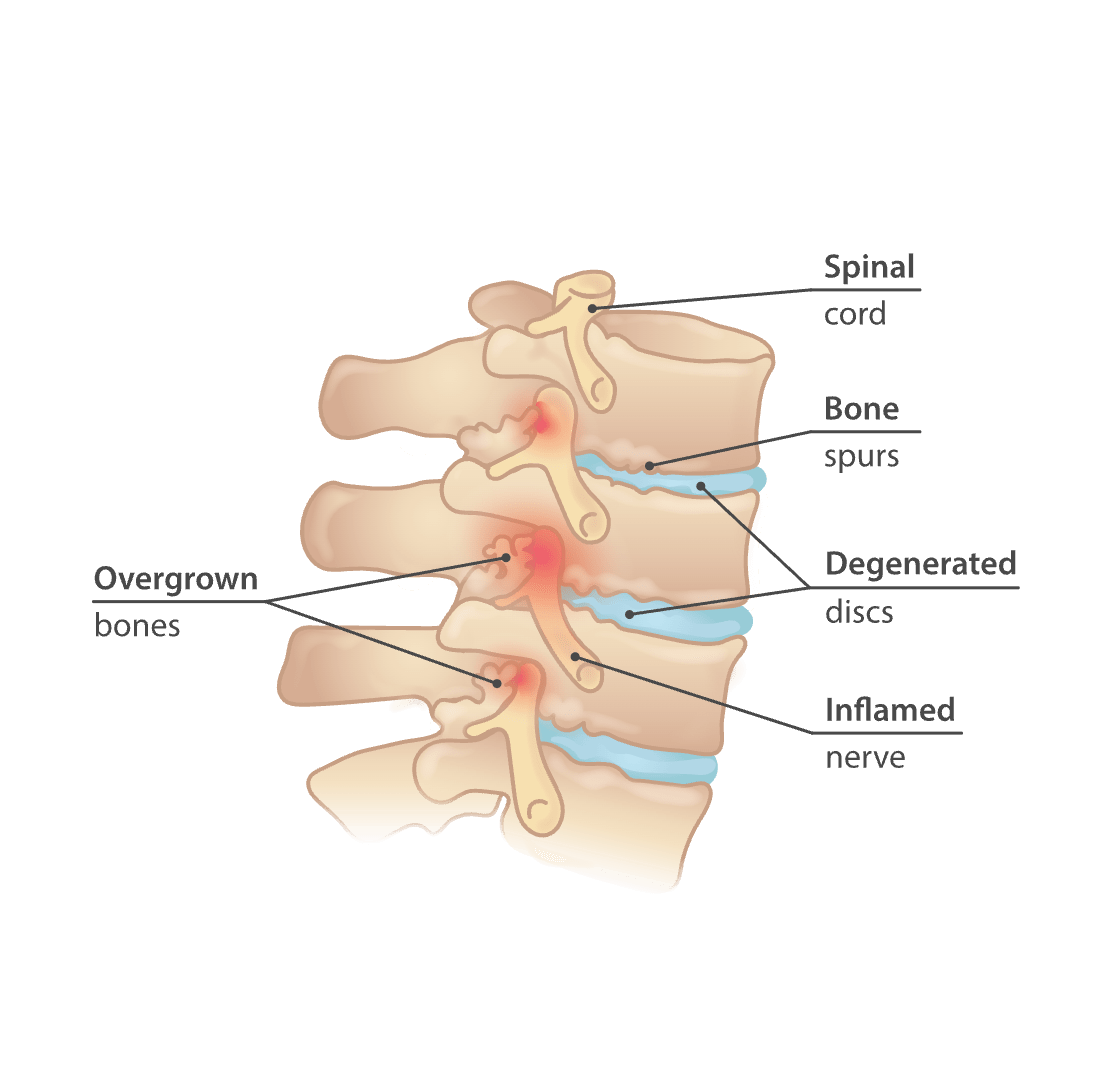 How Do I Get Rid Of A Bone Spur On The Top Of My Foot