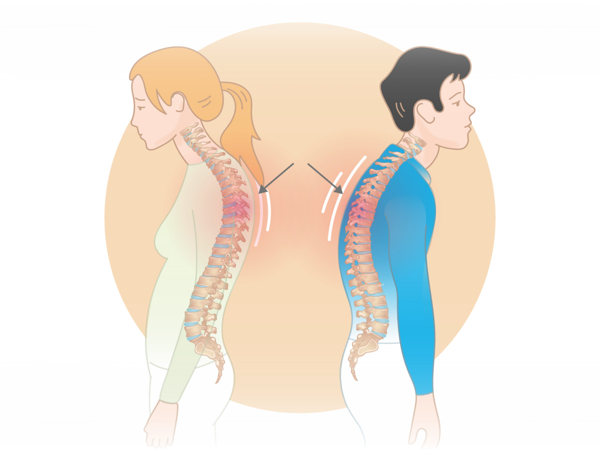 Hump Behind the Shoulders: Causes, Diagnosis, and Treatments