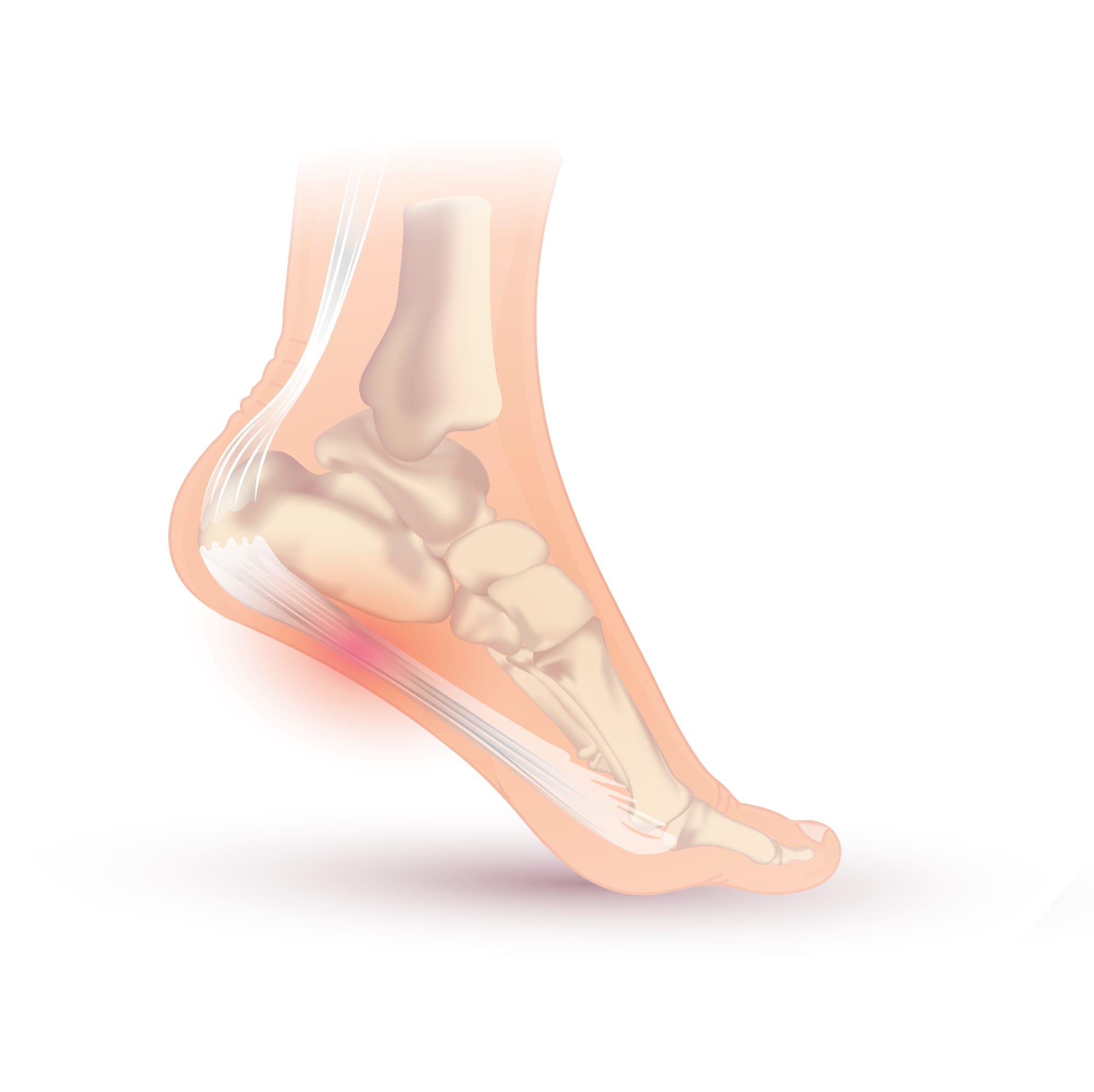 Free plantar fasciitis illustrations and infographics