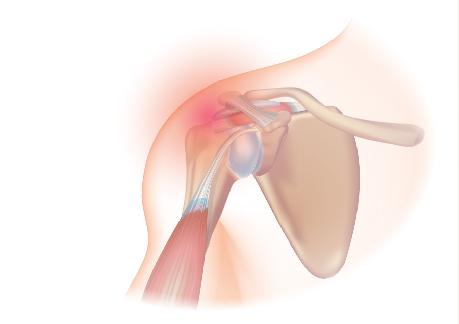 Rotator cuff syndrome