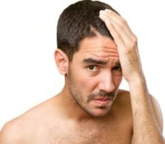  hair transplant, Baldness