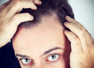 hair transplant, Baldness