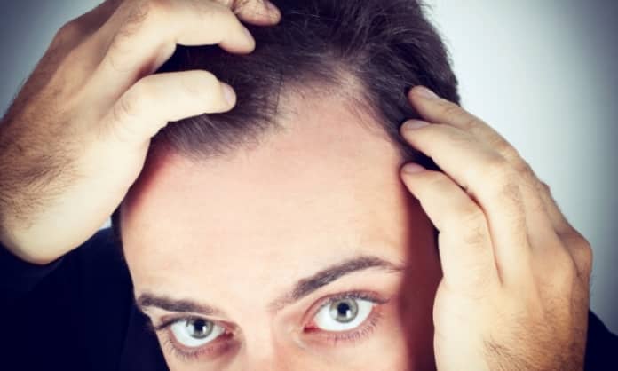 hair transplant, Baldness