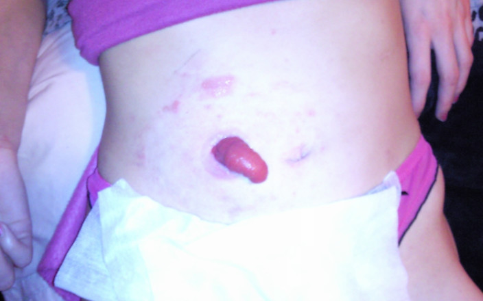 My Stoma