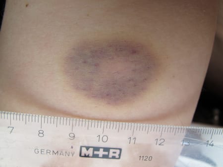 Hematom Skadedokumentation – behandlingsöversikt | Internetmedicin