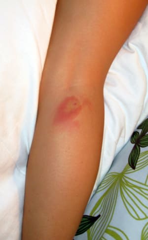 Borreliose Behandling () Borreliose Behandling