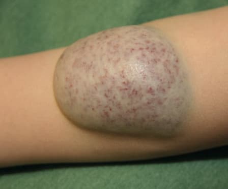 Non-involuting Congenital Hemangioma