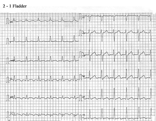 ekg-atlas-supraventrikul-ra-arytmier-behandlings-versikt